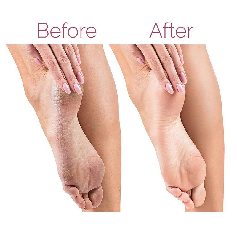 Foot File Callus Remover | Electric Pedicure